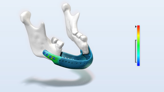 jaw replacement implants