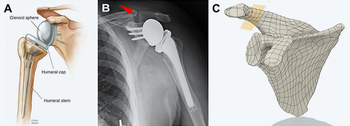 Grammont Implantatdesign für RSA (Reverse Shoulder Arthroplasty) (A). Exemplarische Acromion Levy Typ II Fraktur (B: roter Pfeil ). Schematische Repräsentation der Frakturebene C).